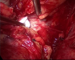 写真４：心膜から胸膜外剥離 