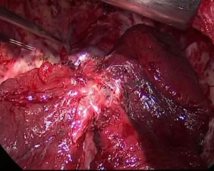 写真９：臓側胸膜剥離完成（換気なし）